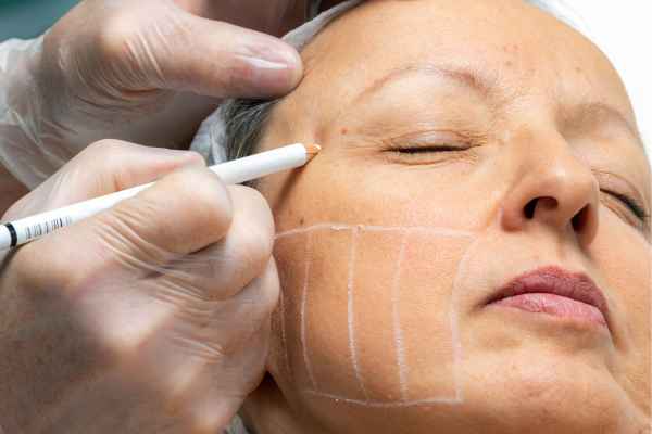 CryoPen: 5 Skin Concerns It May Be Used to Treat 4 What should you ask before having CryoPen treatment Elstree?