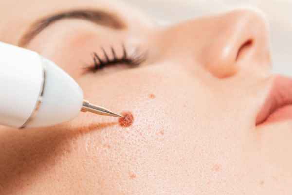 CryoPen: 5 Skin Concerns It May Be Used to Treat 3 What actually happens during a CryoPen treatment Elstree?