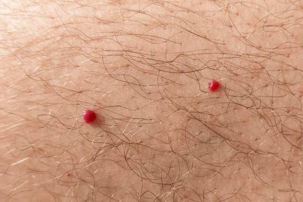 CryoPen: 5 Skin Concerns It May Be Used to Treat 2 cherry angioma removal Elstree