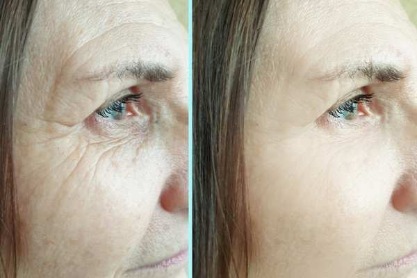 Why Do People Choose HIFU for a Non-Surgical Facelift? 4 How long can HIFU results last Elstree?