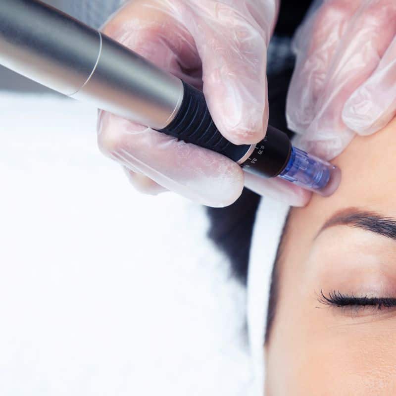 Morpheus8 treatment Elstree from Lipo Sculpt - Book in today!