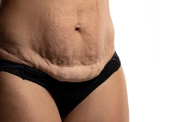 Lost the Weight but Not the Loose Skin? 1 image of womans stomach after weight loss showing loose skin Elstree